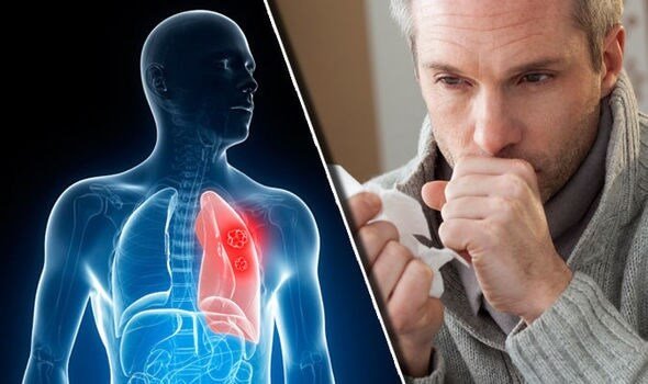लंग कैंसर के शुरुआती लक्षण तथा इसकी जांच कैसे होती है ? Lung cancer symptoms test janch 